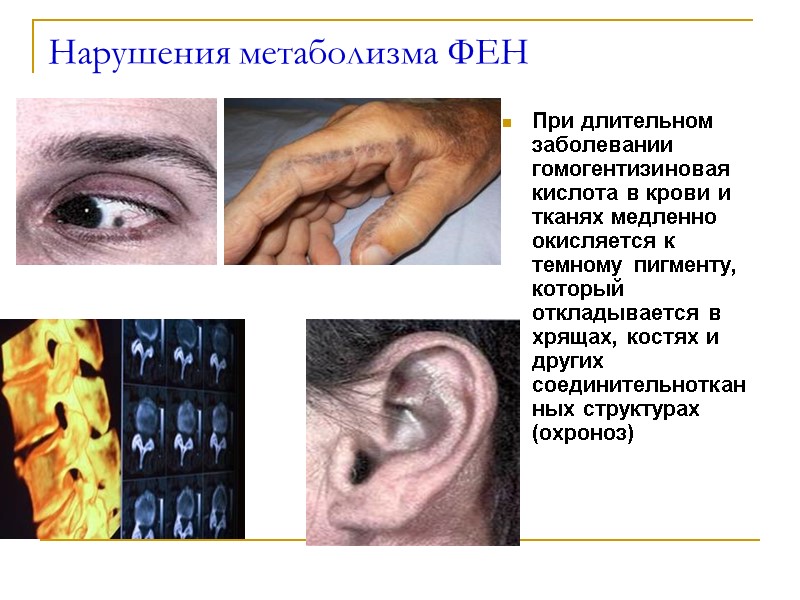 Нарушения метаболизма ФЕН При длительном заболевании гомогентизиновая кислота в крови и тканях медленно окисляется